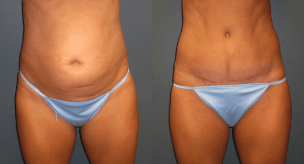 Tummy Tuck or Liposuction?
