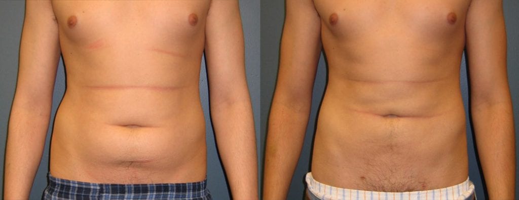 Before and After Liposuction Gallery
