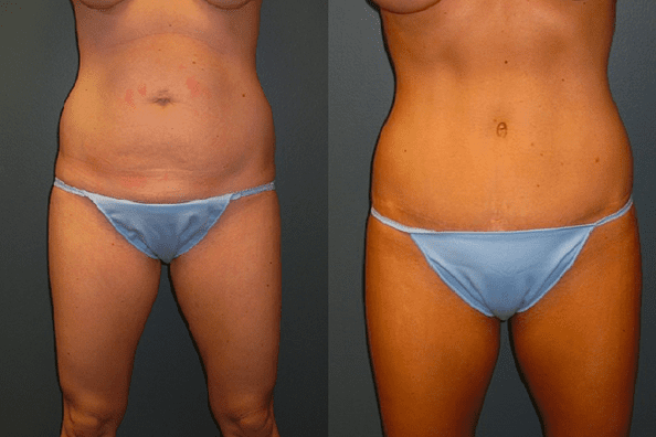 Can I Get a Tummy Tuck if I've Never Been Pregnant? - Dr. Matthew Conrad