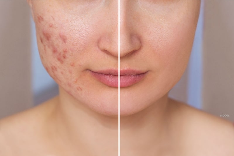 Reducing blemishes and scars